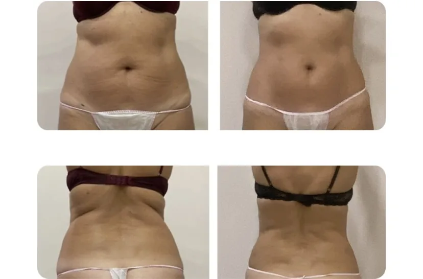 Comparativa aportada por Coimbra: abdomen y espalda, dos perspectivas; antes y después