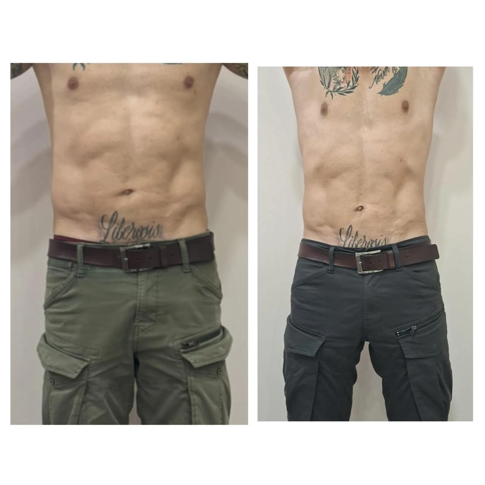 Comparativa aportada por Coimbra: abdomen, vista frontal; antes y después