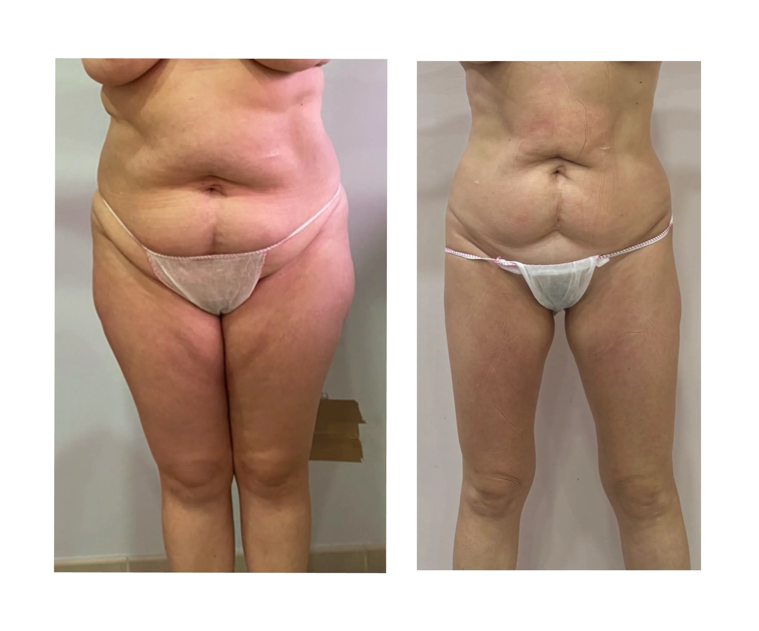 Comparativa aportada por Coimbra: abdomen y muslos, vista frontal; antes y después