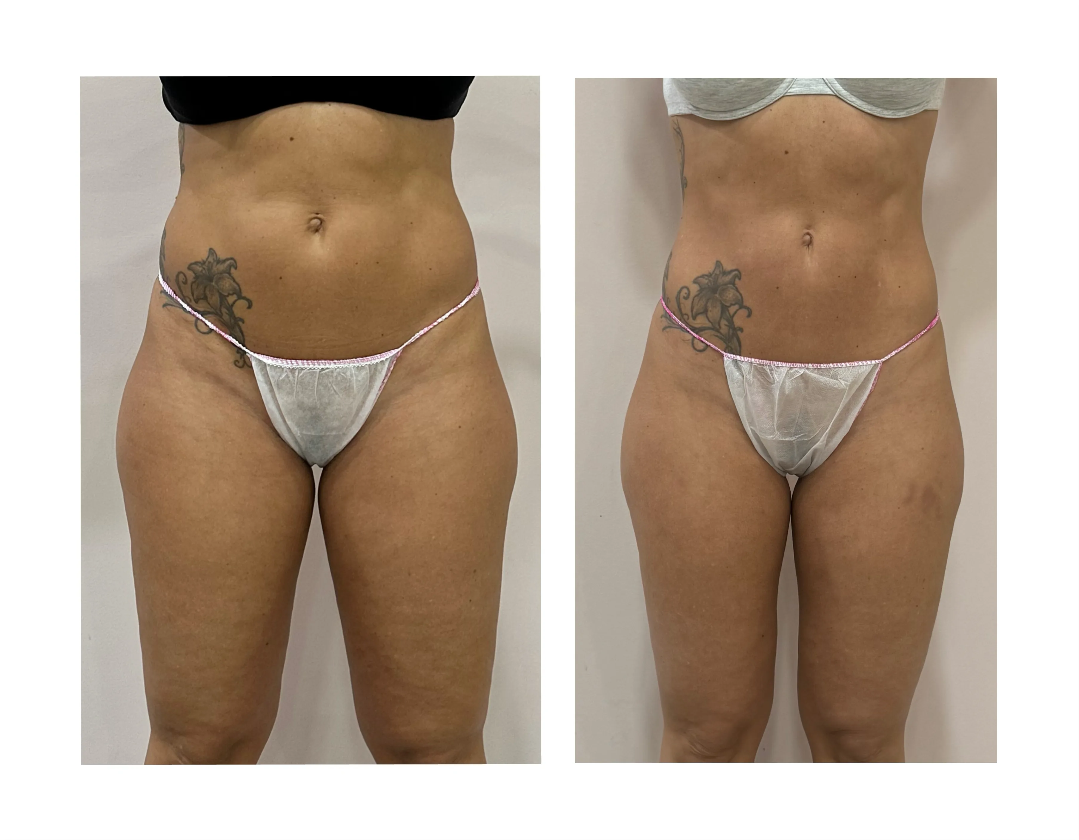 Comparativa aportada por Coimbra: abdomen, vista frontal; antes y después