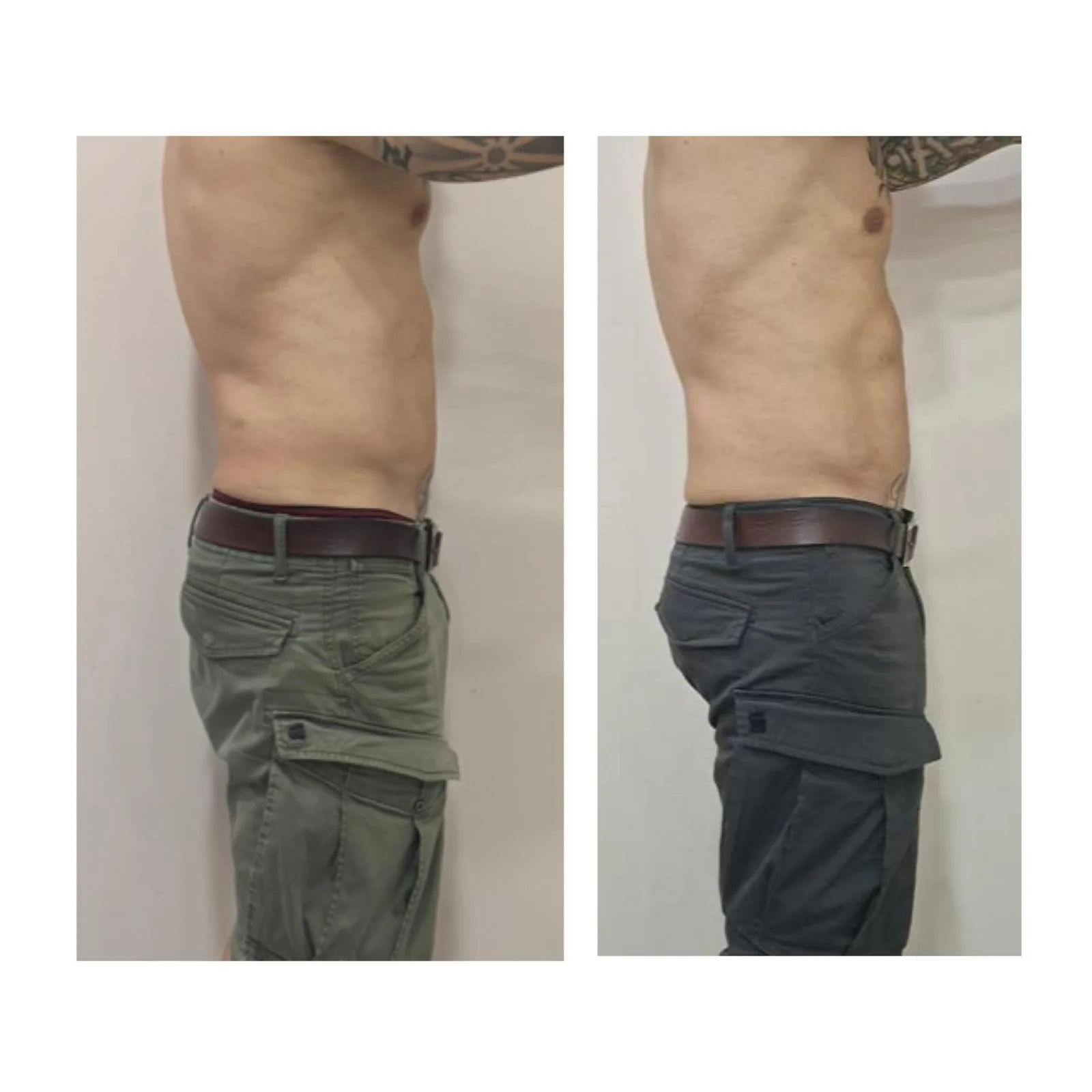 Comparativa aportada por Coimbra: abdomen, vista de perfil; antes y después