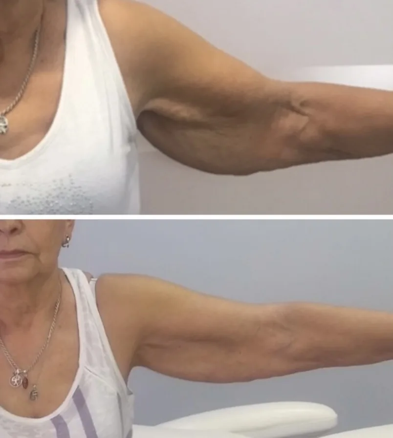 Comparativa aportada por Coimbra: cara interna del brazo; antes y después