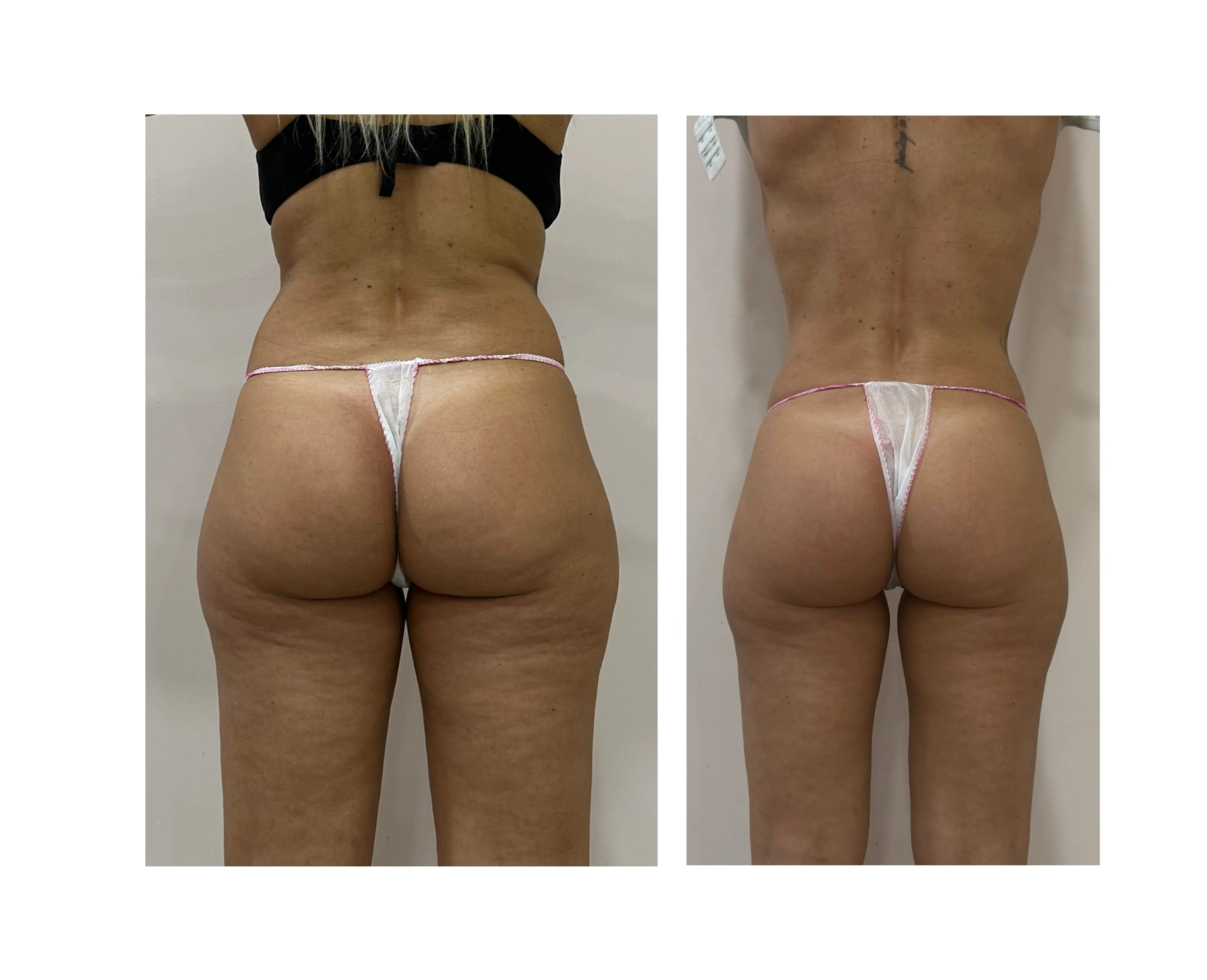 Comparativa aportada por Coimbra: caderas y muslos, vista posterior; antes y después