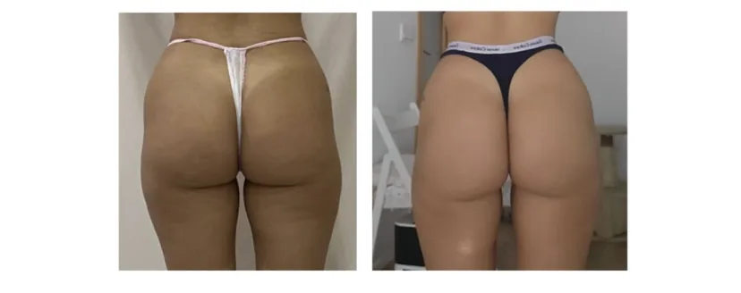 Comparativa aportada por Coimbra: caderas y muslos, vista posterior; antes y después
