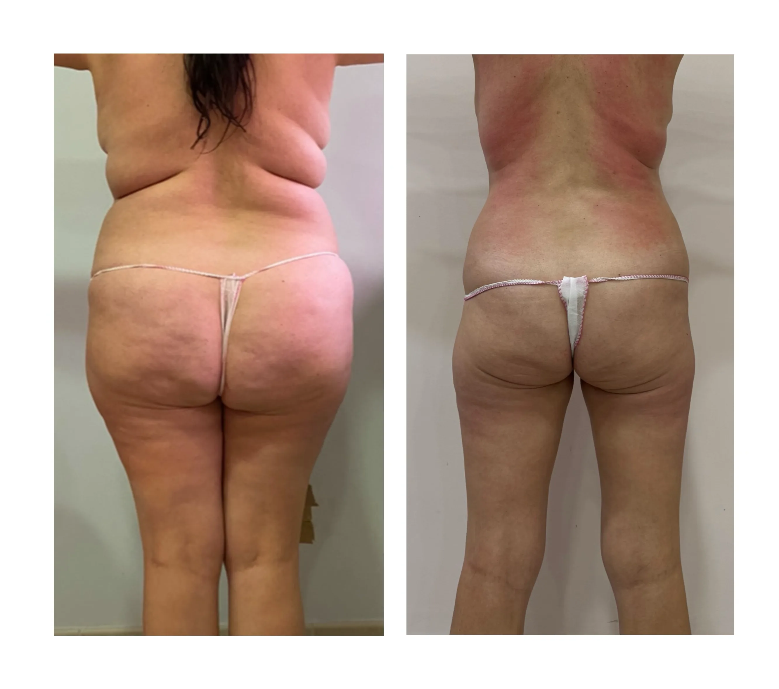 Comparativa aportada por Coimbra: espalda y caderas, vista posterior; antes y después
