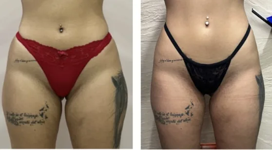 Comparativa aportada por Coimbra: muslos y caderas, vista frontal; antes y después